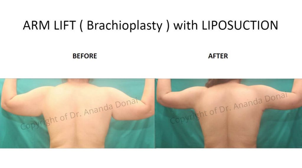ARM LIFT-Brachioplasty-with-LIPOSUCTION