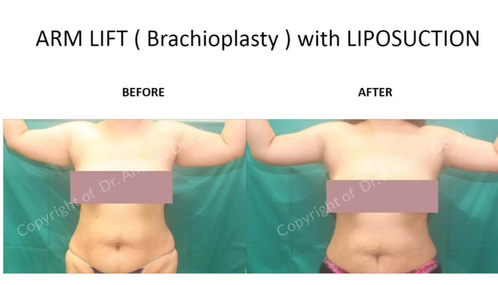 ARM-LIFT-Brachioplasty-with-LIPOSUCTION