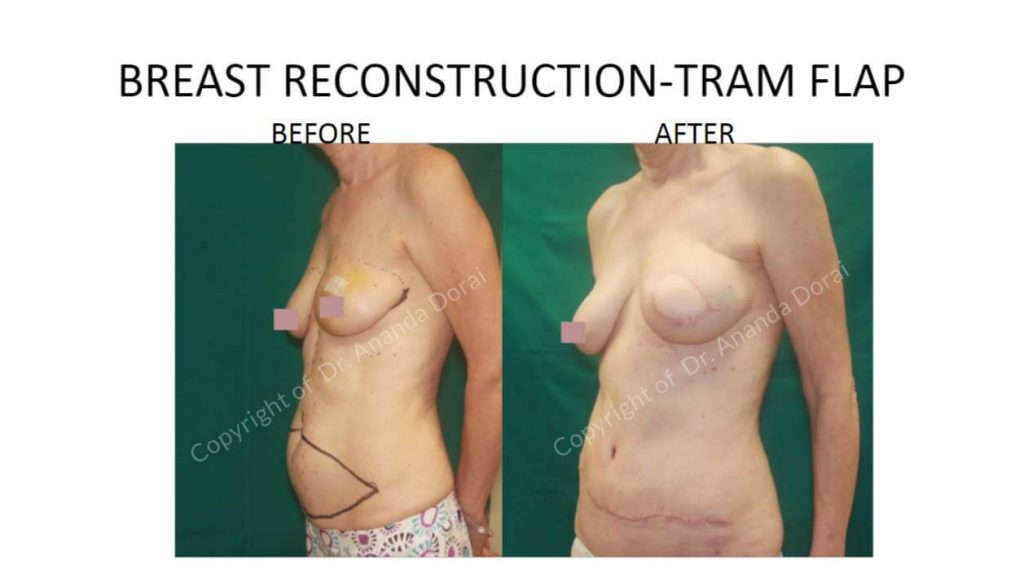 BREAST RECONSTRUCTION TRAM FLAP