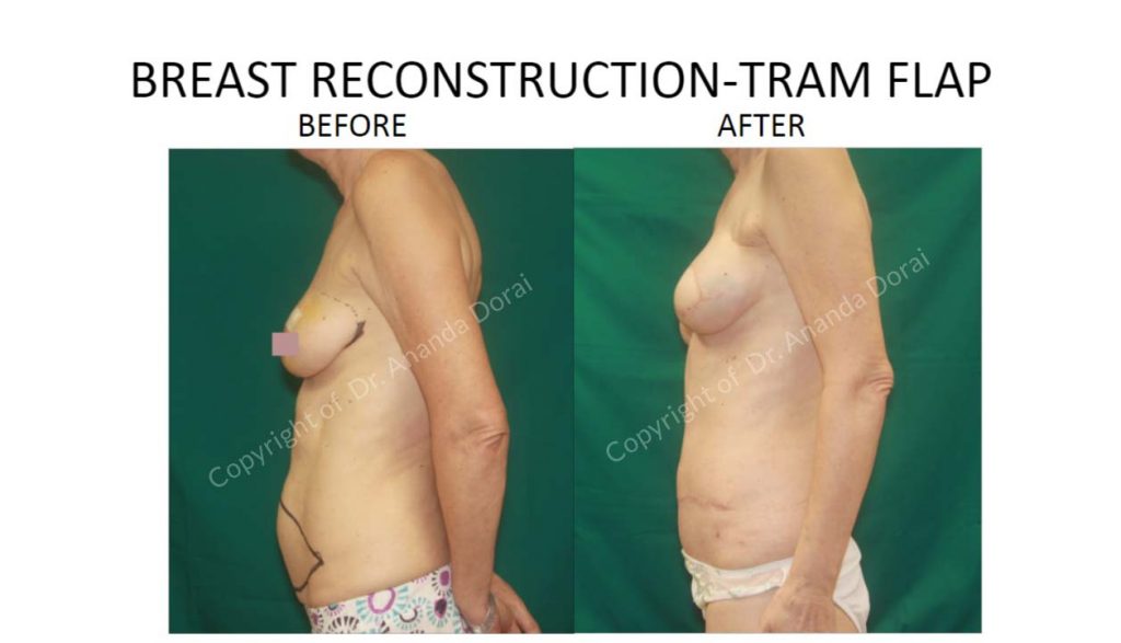 BREAST RECONSTRUCTION TRAM FLAP