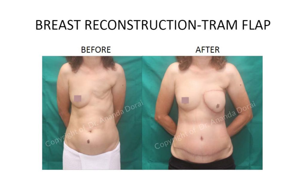 BREAST RECONSTRUCTION TRAM FLAP