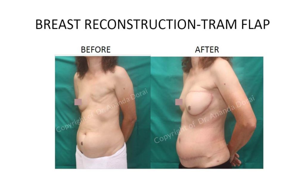 BREAST RECONSTRUCTION TRAM FLAP