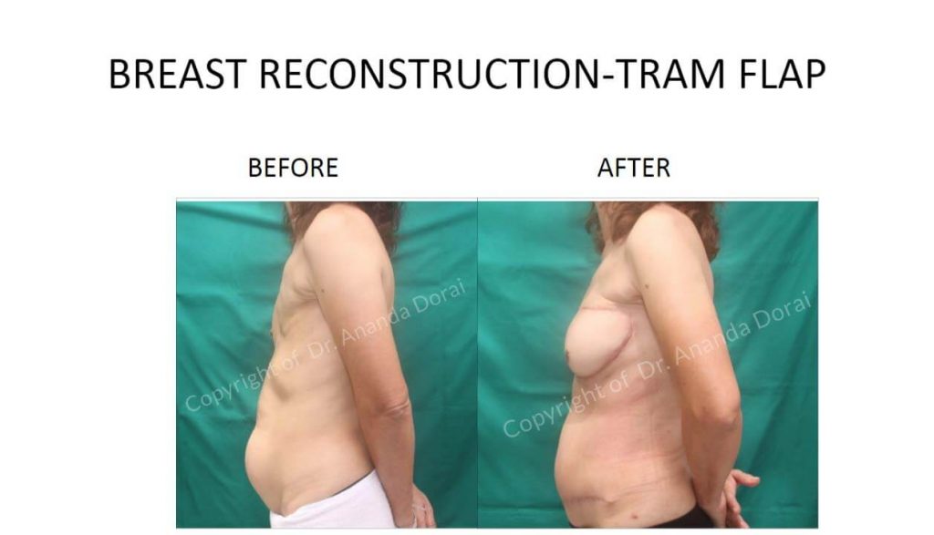 BREAST RECONSTRUCTION TRAM FLAP