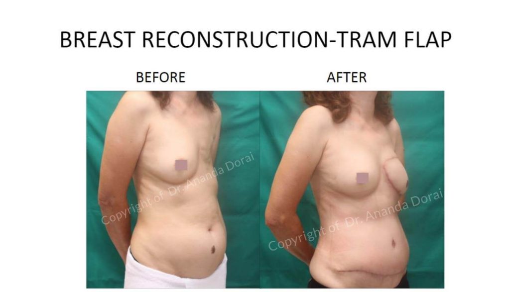 BREAST RECONSTRUCTION TRAM FLAP