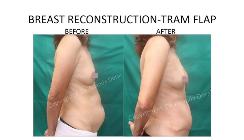 BREAST RECONSTRUCTION TRAM FLAP