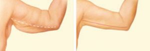 inner-arm-incision
