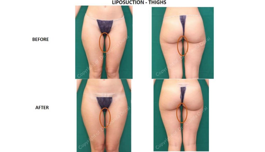 LIPOSUCTION THIGHS