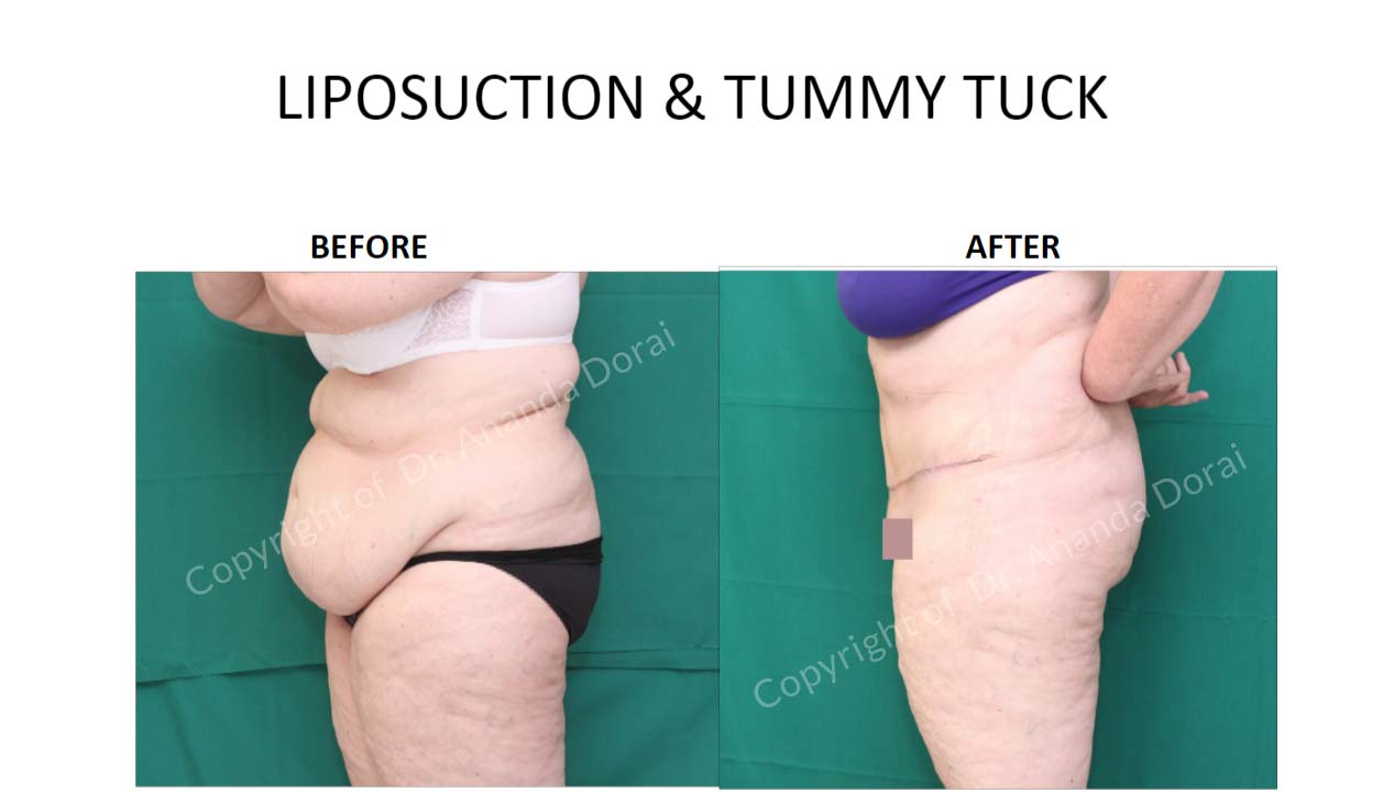 Tummy Tuck Surgery (Abdominoplasty) in Malaysia Cosmetic