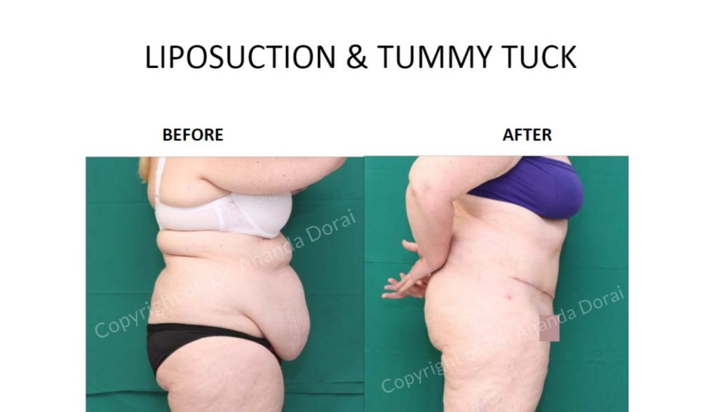 LIPOSUCTION TUMMY TUCK