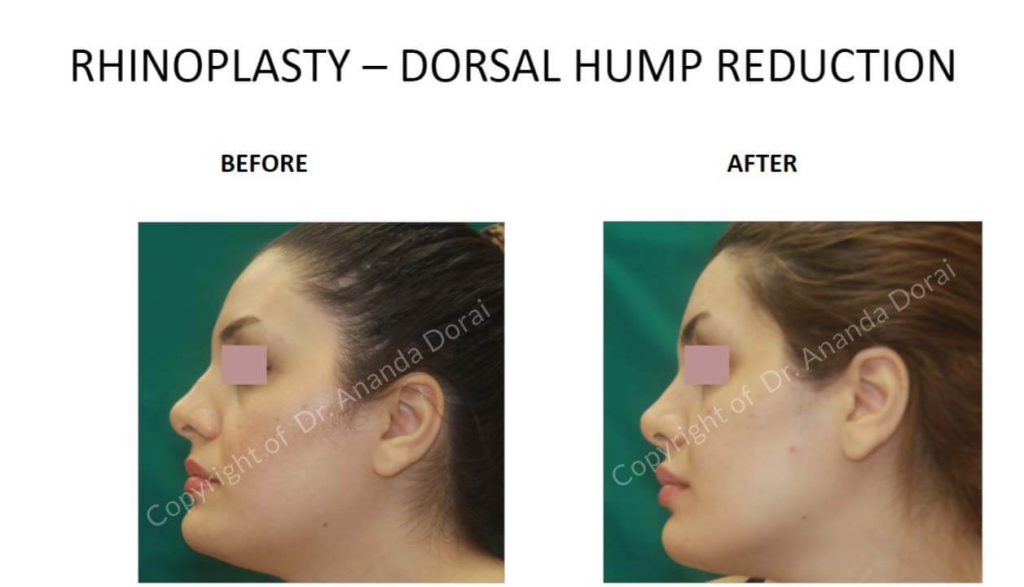 RHINOPLASTY DORSAL HUMP REDUCTION