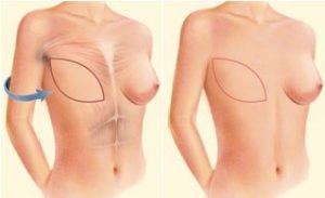 breast-reconstruction-2