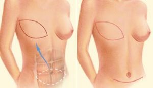 breast-reconstruction