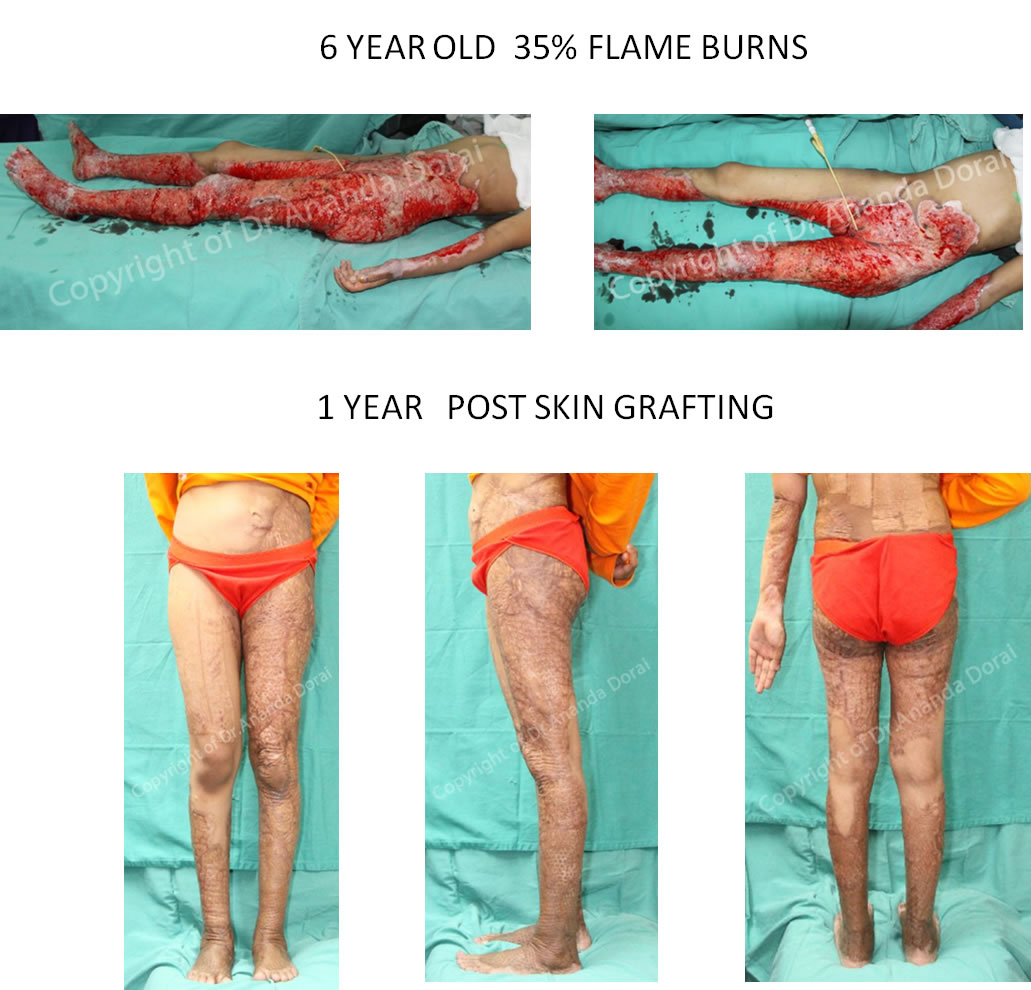 Burn Injuries