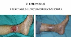 chronic-wounds-1
