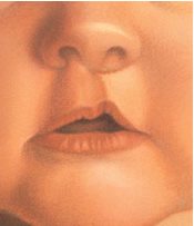cleft-lip-and-palate-3