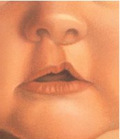 Cleft Lip and Palate