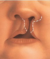 cleft-lip-and-palate